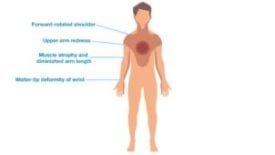 Erbs Palsy Key Facts