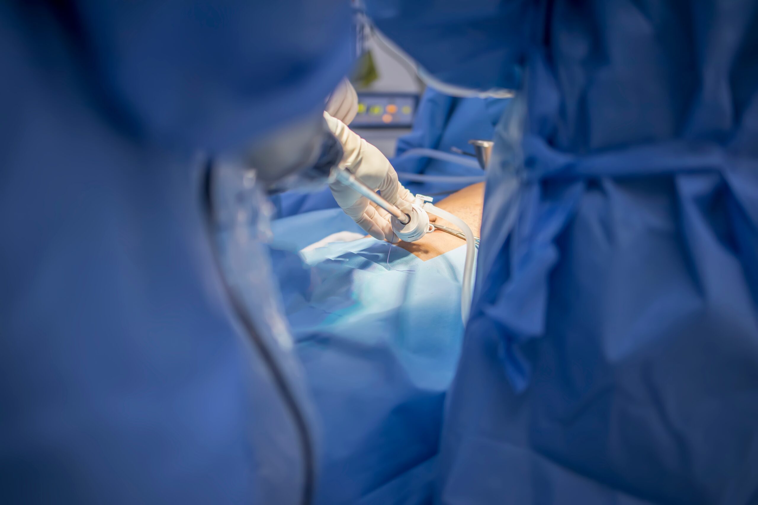 Picture of Bile Duct Injury After Gallbladder Removal: What Should You Do? - Ison ...