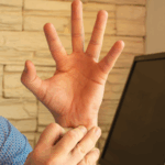 hand arm vibration syndrome