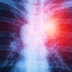mesothelioma claim