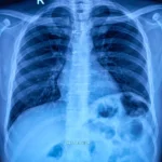 Bilateral Pleural Thickening & Living with Asbestos Damage